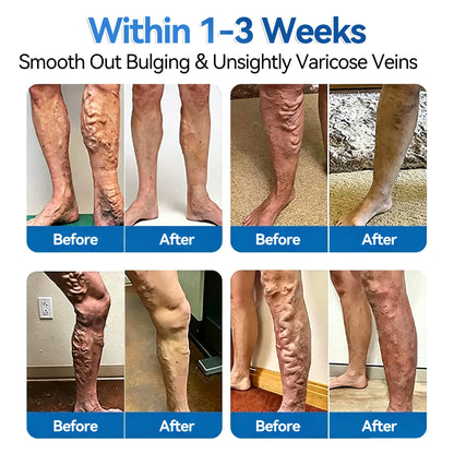 ✅️🏃𝐅𝐥𝐨𝐫𝐢𝐬𝐦𝐚®🍁💖 𝐕𝐞𝐢𝐧𝐑𝐞𝐩𝐚𝐢𝐫 𝐌𝐢𝐜𝐫𝐨𝐧𝐞𝐞𝐝𝐥𝐞 𝐏𝐚𝐭𝐜𝐡 𝐑𝐨𝐥𝐥⚡Instant Relief, Long-Term Results